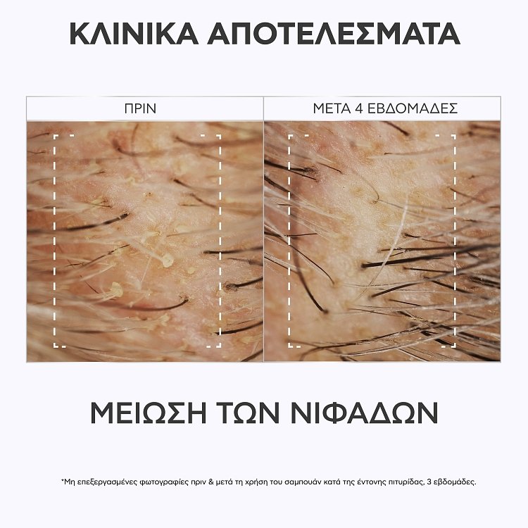 Apivita Dandruff Relief Scalp Lotion για το Ευαίσθητο τριχωτό 100ml