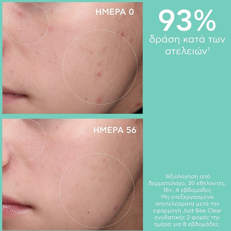 Apivita Just Bee Clear Κρέμα κατά των Ατελειών – Ενυδάτωση & Ματ Αποτέλεσμα με Propolis AmC & Φυτικό Σαλικυλικό Οξύ 40ml